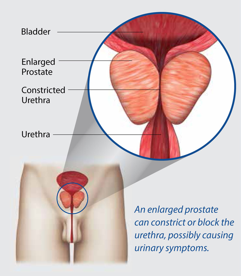 Enlarged Prostate: Causes, Symptoms and Treatment | Facebook